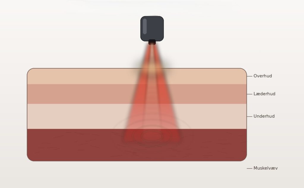 laserbehandling